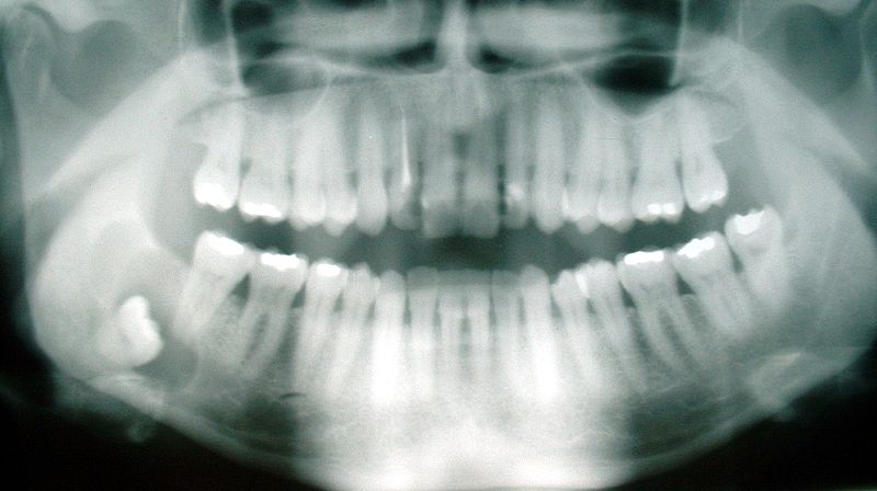 Próchnica zębów